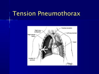 Tension PneumothoraxTension Pneumothorax
 