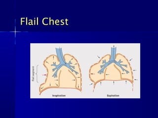 Flail ChestFlail Chest
 