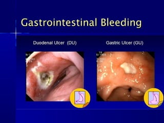 Gastrointestinal BleedingGastrointestinal Bleeding
 