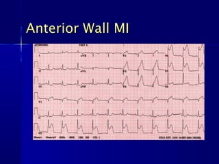 Anterior Wall MIAnterior Wall MI
 