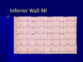 Inferior Wall MIInferior Wall MI
 