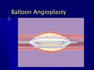 Balloon AngioplastyBalloon Angioplasty
 