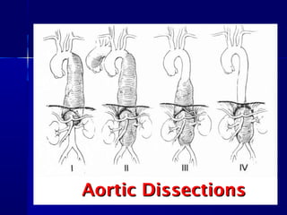 Aortic DissectionsAortic Dissections
 