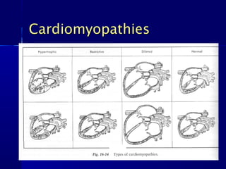 CardiomyopathiesCardiomyopathies
 