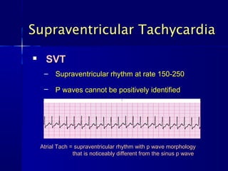 Supraventricular TachycardiaSupraventricular Tachycardia

SVTSVT
– Supraventricular rhythm at rate 150-250Supraventricular rhythm at rate 150-250
– P waves cannot be positively identifiedP waves cannot be positively identified
Atrial Tach = supraventricular rhythm with p wave morphologyAtrial Tach = supraventricular rhythm with p wave morphology
that is noticeably different from the sinus p wavethat is noticeably different from the sinus p wave
 