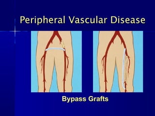 Peripheral Vascular DiseasePeripheral Vascular Disease
Bypass GraftsBypass Grafts
 