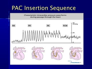 PAC Insertion SequencePAC Insertion Sequence
 