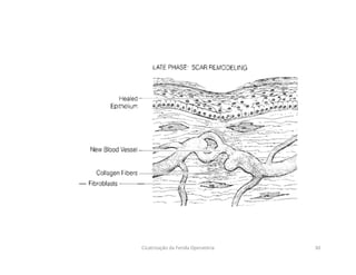 30Cicatrização da Ferida Operatória
 