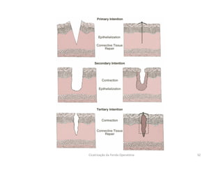 32Cicatrização da Ferida Operatória
 