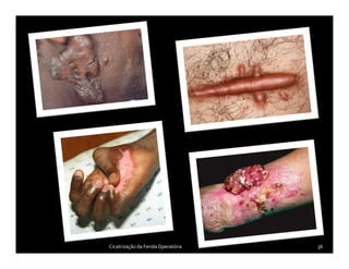 36Cicatrização da FeridaOperatória
 