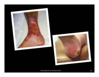 Cicatrização da FeridaOperatória 38
 