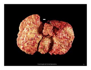 Cicatrização da FeridaOperatória 9
 