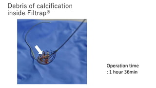 CROSSVAC - A new and aggressive flossing strategy | PPTX