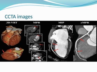 Comprehensive Overview of Coronary CT Angiography in CAD Diagnosis and ...