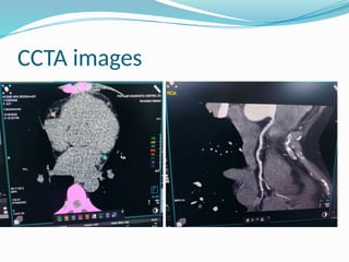 Comprehensive Overview of Coronary CT Angiography in CAD Diagnosis and ...
