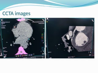 Comprehensive Overview of Coronary CT Angiography in CAD Diagnosis and ...