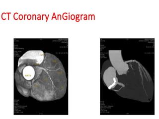 Comprehensive Overview of Coronary CT Angiography in CAD Diagnosis and ...