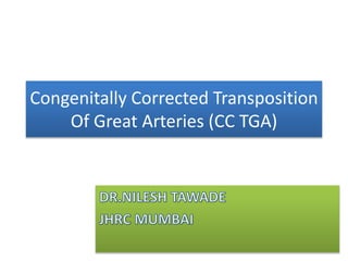Congenitally Corrected Transposition
Of Great Arteries (CC TGA)
 