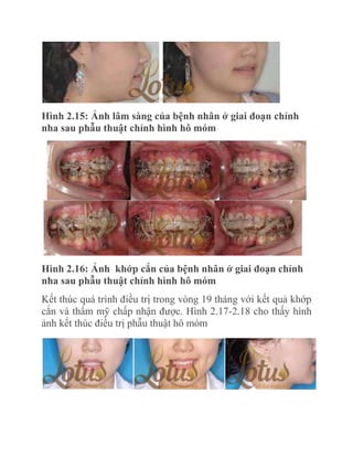 Hình 2.15: Ảnh lâm sàng của bệnh nhân ở giai đoạn chỉnh
nha sau phẫu thuật chỉnh hình hô móm

Hình 2.16: Ảnh khớp cắn của bệnh nhân ở giai đoạn chỉnh
nha sau phẫu thuật chỉnh hình hô móm
Kết thúc quá trình điều trị trong vòng 19 tháng với kết quả khớp
cắn và thẩm mỹ chấp nhận được. Hình 2.17-2.18 cho thấy hình
ảnh kết thúc điều trị phẫu thuật hô móm

 