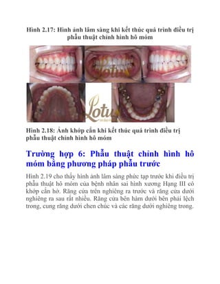 Hình 2.17: Hình ảnh lâm sàng khi kết thúc quá trình điều trị
phẫu thuật chỉnh hình hô móm

Hình 2.18: Ảnh khớp cắn khi kết thúc quá trình điều trị
phẫu thuật chỉnh hình hô móm

Trƣờng hợp 6: Phẫu thuật chỉnh hình hô
móm bằng phƣơng pháp phẫu trƣớc
Hình 2.19 cho thấy hình ảnh lâm sàng phức tạp trước khi điều trị
phẫu thuật hô móm của bệnh nhân sai hình xương Hạng III có
khớp cắn hở. Răng cửa trên nghiêng ra trước và răng cửa dưới
nghiêng ra sau rất nhiều. Răng cửa bên hàm dưới bên phải lệch
trong, cung răng dưới chen chúc và các răng dưới nghiêng trong.

 