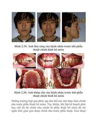 Hình 2.19: Ảnh lâm sàng của bệnh nhân trƣớc khi phẫu
thuật chỉnh hình hô móm

Hình 2.20: Ảnh khớp cắn của bệnh nhân trƣớc khi phẫu
thuật chỉnh hình hô móm
Những trường hợp quá phức tạp như thế này nên thực hiện chỉnh
nha trước phẫu thuật hô móm. Tuy nhiên, khi lập kế hoạch phải
hạn chế tối đa chỉnh nha chuẩn bị phẫu thuật hô móm để rút
ngắn thời gian giai đoạn chỉnh nha trước phẫu thuật. Giai đoạn

 