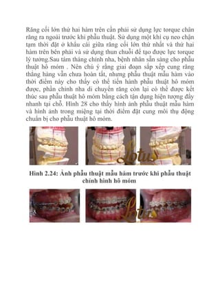Răng cối lớn thứ hai hàm trên cần phải sử dụng lực torque chân
răng ra ngoài trước khi phẫu thuật. Sử dụng một khí cụ neo chận
tạm thời đặt ở khẩu cái giữa răng cối lớn thứ nhất và thứ hai
hàm trên bên phải và sử dụng thun chuỗi để tạo được lực torque
lý tưởng.Sau tám tháng chỉnh nha, bệnh nhân sẵn sàng cho phẫu
thuật hô móm . Nên chú ý rằng giai đoạn sắp xếp cung răng
thẳng hàng vẫn chưa hoàn tất, nhưng phẫu thuật mẫu hàm vào
thời điểm này cho thấy có thể tiến hành phẫu thuật hô móm
được, phần chỉnh nha di chuyển răng còn lại có thể được kết
thúc sau phẫu thuật hô móm bằng cách tận dụng hiện tượng đẩy
nhanh tại chỗ. Hình 28 cho thấy hình ảnh phẫu thuật mẫu hàm
và hình ảnh trong miệng tại thời điểm đặt cung môi thụ động
chuẩn bị cho phẫu thuật hô móm.

Hình 2.24: Ảnh phẫu thuật mẫu hàm trƣớc khi phẫu thuật
chỉnh hình hô móm

 