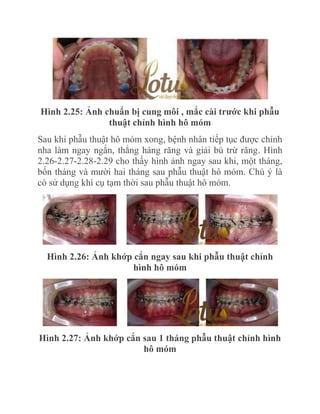 Hình 2.25: Ảnh chuẩn bị cung môi , mắc cài trƣớc khi phẫu
thuật chỉnh hình hô móm
Sau khi phẫu thuật hô móm xong, bệnh nhân tiếp tục được chỉnh
nha làm ngay ngắn, thẳng hàng răng và giải bù trừ răng. Hình
2.26-2.27-2.28-2.29 cho thấy hình ảnh ngay sau khi, một tháng,
bốn tháng và mười hai tháng sau phẫu thuật hô móm. Chú ý là
có sử dụng khí cụ tạm thời sau phẫu thuật hô móm.

Hình 2.26: Ảnh khớp cắn ngay sau khi phẫu thuật chỉnh
hình hô móm

Hình 2.27: Ảnh khớp cắn sau 1 tháng phẫu thuật chỉnh hình
hô móm

 