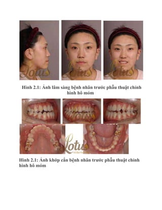 Hình 2.1: Ảnh lâm sàng bệnh nhân trƣớc phẫu thuật chỉnh
hình hô móm

Hình 2.1: Ảnh khớp cắn bệnh nhân trƣớc phẫu thuật chỉnh
hình hô móm

 