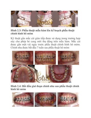 Hình 2.3: Phẫu thuật mẫu hàm lên kế hoạch phẫu thuật
chỉnh hình hô móm
Kỹ thuật gắn mắc cài gián tiếp được sử dụng trong trường hợp
này cho phép bẻ cung môi thụ động trên mẫu hàm. Mắc cài
được gắn một vài ngày trước phẫu thuật chỉnh hình hô móm.
Chỉnh nha được bắt đầu 7 tuần sau phẫu thuật hô móm

Hình 2.4: Bắt đầu giai đoạn chỉnh nha sau phẫu thuật chỉnh
hình hô móm

 