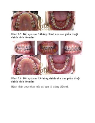 Hình 2.5: Kết quả sau 3 tháng chỉnh nha sau phẫu thuật
chỉnh hình hô móm

Hình 2.6: Kết quả sau 13 tháng chỉnh nha sau phẫu thuật
chỉnh hình hô móm
Bệnh nhân được tháo mắc cài sau 16 tháng điều trị.

 