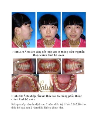 Hình 2.7: Ảnh lâm sàng kết thúc sau 16 tháng điều trị phẫu
thuật chỉnh hình hô móm

Hình 2.8: Ảnh khớp cắn kết thúc sau 16 tháng phẫu thuật
chỉnh hình hô móm
Kết quả này vẫn ổn định sau 2 năm điều trị. Hình 2.9-2.10 cho
thấy kết quả sau 2 năm tháo khí cụ chỉnh nha.

 