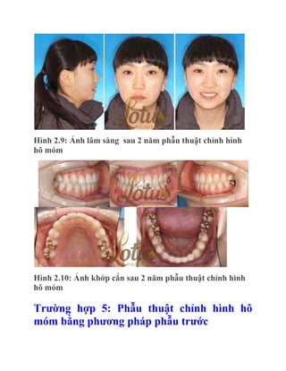 Hình 2.9: Ảnh lâm sàng sau 2 năm phẫu thuật chỉnh hình
hô móm

Hình 2.10: Ảnh khớp cắn sau 2 năm phẫu thuật chỉnh hình
hô móm

Trƣờng hợp 5: Phẫu thuật chỉnh hình hô
móm bằng phƣơng pháp phẫu trƣớc

 