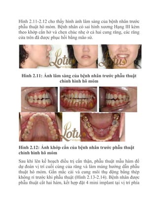 Hình 2.11-2.12 cho thấy hình ảnh lâm sàng của bệnh nhân trước
phẫu thuật hô móm. Bệnh nhân có sai hình xương Hạng III kèm
theo khớp cắn hở và chen chúc nhẹ ở cả hai cung răng, các răng
cửa trên đã được phục hồi bằng mão sứ.

Hình 2.11: Ảnh lâm sàng của bệnh nhân trƣớc phẫu thuật
chỉnh hình hô móm

Hình 2.12: Ảnh khớp cắn của bệnh nhân trƣớc phẫu thuật
chỉnh hình hô móm
Sau khi lên kế hoạch điều trị cẩn thận, phẫu thuật mẫu hàm để
dự đoán vị trí cuối cùng của răng và làm máng hướng dẫn phẫu
thuật hô móm. Gắn mắc cài và cung môi thụ động bằng thép
không rỉ trước khi phẫu thuật (Hình 2.13-2.14). Bệnh nhân được
phẫu thuật cắt hai hàm, kết hợp đặt 4 mini implant tại vị trí phía

 