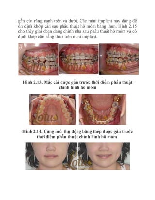 gần của răng nanh trên và dưới. Các mini implant này dùng để
ổn định khớp cắn sau phẫu thuật hô móm bằng thun. Hình 2.15
cho thấy giai đoạn dang chỉnh nha sau phẫu thuật hô móm và cố
định khớp cắn bằng thun trên mini implant.

Hình 2.13. Mắc cài đƣợc gắn trƣớc thời điểm phẫu thuật
chỉnh hình hô móm

Hình 2.14. Cung môi thụ động bằng thép đƣợc gắn trƣớc
thời điểm phẫu thuật chỉnh hình hô móm

 