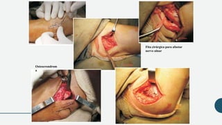 Fita cirúrgica para afastar
nervo ulnar
Osteocrondrom
a
 