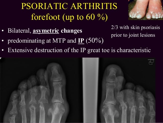 C cyteval arthritis and inflammatory foot jfim hanoi 2015