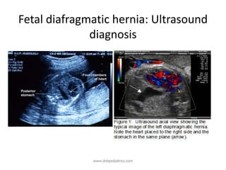 Fetal diafragmatic hernia: Ultrasound
diagnosis
www.dnbpediatrics.com
 