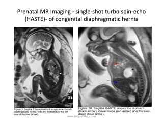Prenatal MR Imaging - single-shot turbo spin-echo
(HASTE)- of congenital diaphragmatic hernia
www.dnbpediatrics.com
 