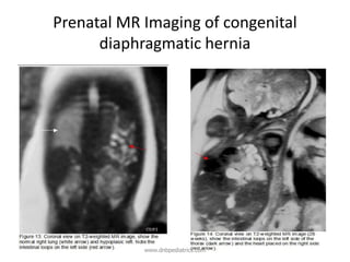 Prenatal MR Imaging of congenital
diaphragmatic hernia
www.dnbpediatrics.com
 