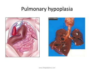 Pulmonary hypoplasia
www.dnbpediatrics.com
 