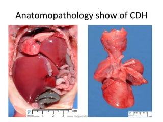 Anatomopathology show of CDH
www.dnbpediatrics.com
 