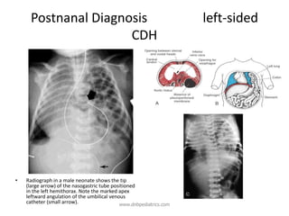 Postnanal Diagnosis left-sided
CDH
• Radiograph in a male neonate shows the tip
(large arrow) of the nasogastric tube positioned
in the left hemithorax. Note the marked apex
leftward angulation of the umbilical venous
catheter (small arrow). www.dnbpediatrics.com
 