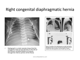 Right congenital diaphragmatic hernia
• Radiograph in a male neonate shows that the
nasogastric tube (arrow) deviates to the left of
the thoracic vertebral bodies as it passes
through the inferior portion of the thorax
www.dnbpediatrics.com
 