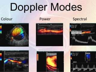 Colour Doppler Basics | PPTX