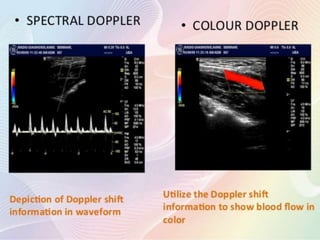 Colour Doppler Basics | PPTX