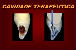 CAVIDADE TERAPÊUTICA