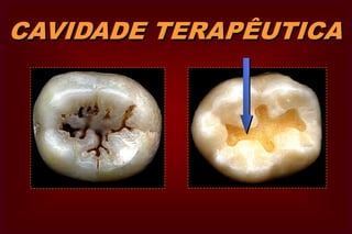 CAVIDADE TERAPÊUTICA