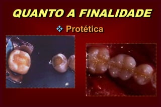  De acordo com número de faces    que ocorre; De acordo com as faces do dente    envolvidas; Classificação de BLACK;