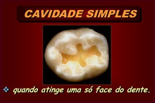 QUANTO A FINALIDADE Cavidade TerapêuticaQUANTO A FINALIDADE Protética DE ACORDO COM O NÚMERO  DE FACES EM QUE OCORRE Simples   