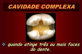  Complexa  quando atinge uma só face do dente.CAVIDADE SIMPLES